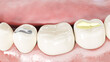 3d rendered illustration of different dental fillings