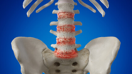 Poster - 3d rendered illustration of arthritic lumbar spine