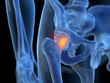 © Sebastian Kaulitzki - 3d rendered illustration of an inflamed hip joint