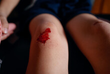 Broke Knee And Bleeds