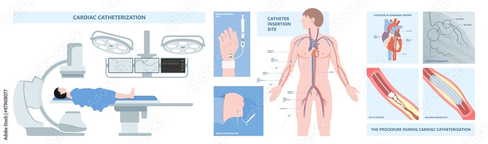 Angiography medical operation Angiogram Biopsy Angioplasty Stent ...