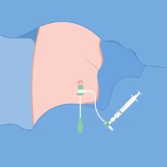 Angiography medical operation Angiogram Biopsy Angioplasty Stent Congenital Heart Defect Ablation CAG arteries plaque X-ray flow diagnose diagnosis blocked CABG valve atrial attack afib infarction