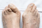 Fototapeta Sypialnia - Top view of male feet together with big bunions and hammer toes over white background. Medical surgery, health care, podiatrist, dermatology concepts