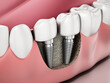 © Destina - 3D illustration of two dental implants on the lower jaw