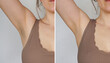 Armpit before and after depilation, laser waxing and sugaring.