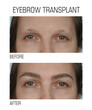 Alopecia. Close up of female eyes before and after eyebrow transplant