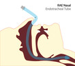 RAE Nasal endotracheal tube for mouth surgeries. Tube positioned to north, helping surgeon in mouth surgeries. 