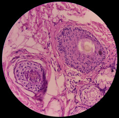 Poster - Tissue from face(biopsy): Microscopic image of intradermal nevus, show small nests of melanocytes in upper dermis with variable pigmentation and cellularity.