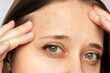 Cropped shot of a young woman's face with the problem of acne. Pimples on the forehead. Allergies, dermatitis, rash, hormonal changes. Problem skin, care and beauty concept. Dermatology, cosmetology