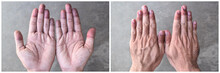 Cyanotic Hands Or Peripheral Cyanosis Or Blue Hands At Asian Man