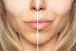 © Марина Демешко - Cropped shot of young caucasian blonde woman's face with lips before and after lip enhancement. Injection of filler in lips. Lip augmentation. Close up