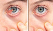 Close up of a blue eye of a girl affected by pterygium before and after surgical removal