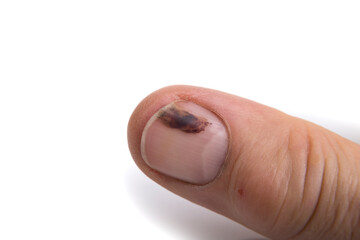 A bruised  fingernail at a white background