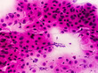 Pap's smear pap stain Microscopic 100x Zoom show High-grade squamous intraepithelial lesion is a pre-cancerous, sexually transmitted disease