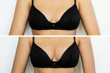Cropped shot of young tanned woman in bra before and after breast  augmentation with silicone implants. The result of a breast lift. Breast  size correction on gray background. Plastic surgery concept Stock