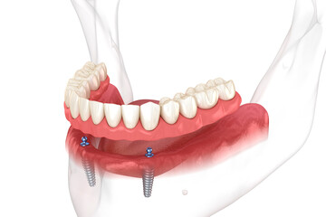 Wall Mural - Mandibular removable prosthesis All on 2 system supported by implants with ball attachments. Medically accurate dental 3D illustration