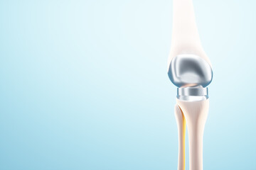 hip implant Medical poster, image of the bones of the knee, artificial joint in the knee. Arthritis, inflammation, fracture, cartilage,. Copy space, 3D illustration, 3D render.