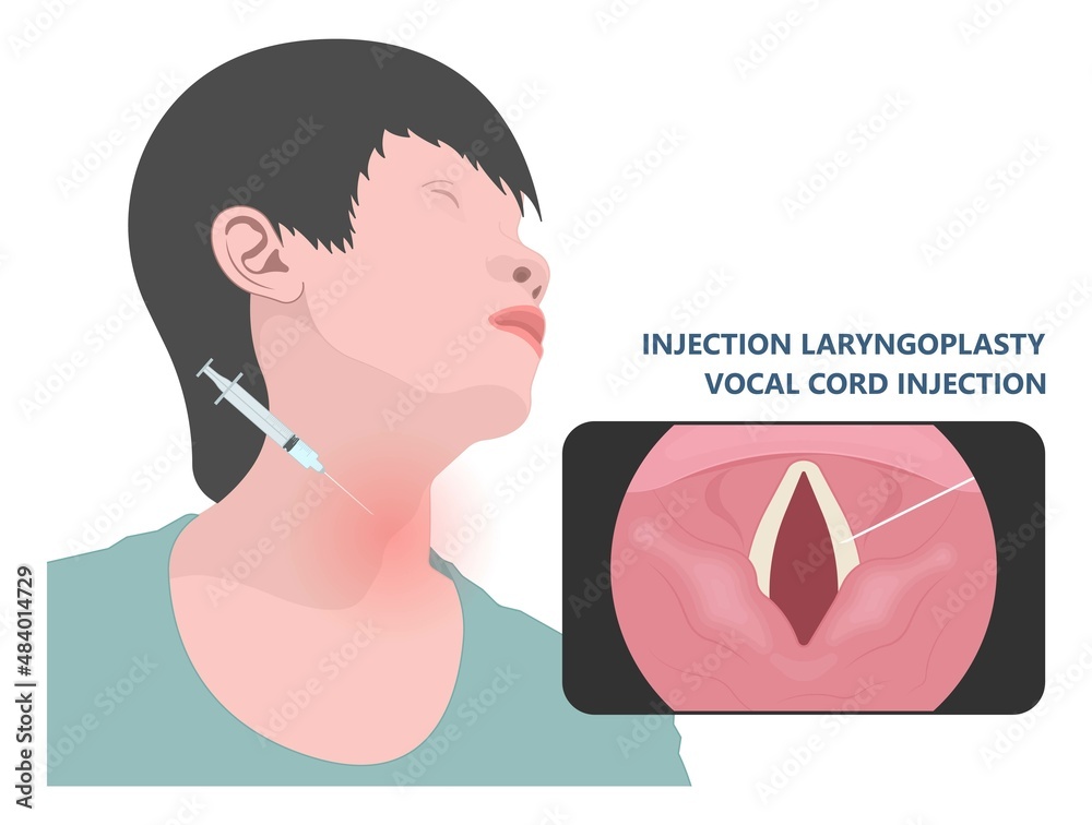 Canvas Print cord vocal Sore loss cough virus viral acute swell