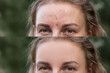 Comparison portrait of young beautiful blond woman before and after skin treatment. Skin care concept. Photo collage, Problem skincare. Oily pore skin. Cause of acne problems