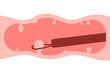 Colonoscopy intestine, polypectomy procedure, removal polyp in colon. Checkup gut, colon surgery. Operation intestine. Vector illustration