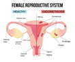 © Ekaterina  Siubarova - Female reproductive system, endometriosis.Scheme of gynecological diseases of the uterus.The state of growth of external tissues within the female body. Structure with painful sick and healthy example