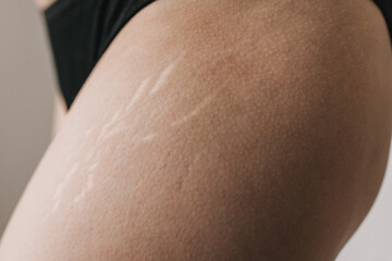 white stretch marks