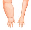 Edema swollen hand or arm. Lymphedema, eodema disease vector. Cartoon human body forearms and hands, swollen and healthy arms, fingers, wrists and elbows comparison