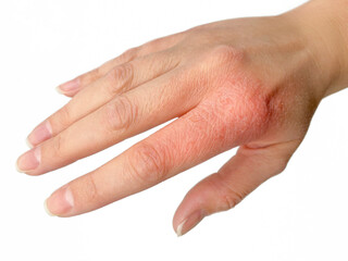 Eczema on the hand close-up. Dermatitis or dry skin from antiseptics.