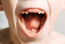 Photo Of A Child's Mouth Missing His Two Front Teeth. The Child Screams And Wants To Have All The Teeth In His Mouth.