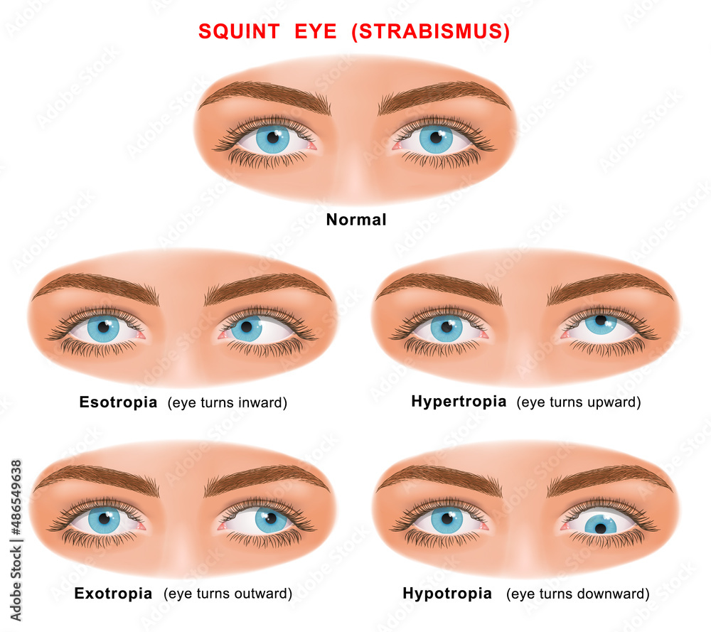 Strabismus or crossed eyes types - esotropia, exotropia, hypertropia,  hypotropia. normal human eyes and eyes with problem. For advertisement and  medical publications. illustration Stock Illustration | Adobe Stock, image size:1000x889