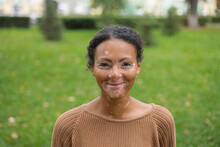 girl with vitiligo in the park
