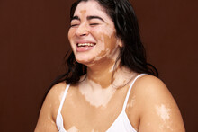 Happy Asian Woman With Vitiligo Skin