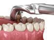 Extraction of Molar tooth damaged by caries. Medically accurate tooth 3D illustration.