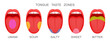 Set of open mouthes with sticking out tongues demonstrating receptor zones marked umami, sour, salty, sweet, bitter flavors. Myth of human taste buds. Vector cartoon illustration