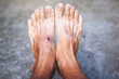 wound of beginning diabetic foot compare with normal foot. Selected focus