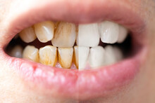 Close-up Of A Man Teeth Before And After Whitening. Health Teeth Concept.