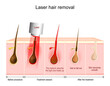© designua - Laser hair removal