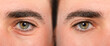 Eyes of man with and without eye bag before and after cosmetic treatment