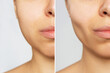 Cropped shot of young woman's face before and after plastic surgery buccal fat pad removal on a white background. A lower part of face with clear highlighted cheekbones. Result of cosmetic surgery