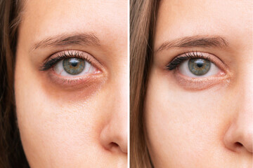 Cropped shot of a young caucasian woman's face with dark circles under eyes before and after cosmetic treatment. Bruises under the eyes caused by fatigue, insomnia. The result of therapy