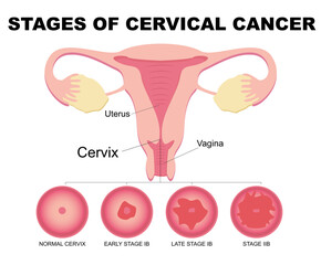 Wall Mural - Flat illustration of cervical cancer stages. Diseases of the female reproductive system.Cervical canal, cervix, vagina. Carcinoma, malignant neoplasm.Biology, anatomy, medicine and scientific concept.