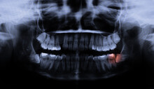 Teeth X-ray With Two Wisdom Teeth Coming In Wrong Direction, Causing Pain. Dentist Photo Of Tooth Problem.