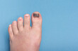 Injury to the nail of the big toe, hematoma and bruising under the nail.