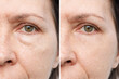 Cropped shot of an elderly caucasian woman's face with puffiness under her eyes and wrinkles before and after treatment. Age-related skin changes, fatigue. Result of blepharoplasty plastic surgery