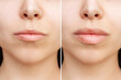 © Марина Демешко - Result of lip augmentation. Cropped shot of young woman's face with lips before and after lip enhancement. Injection of filler in lips