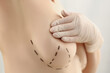 Lady client with marking on boob for future cosmetic surgery operation