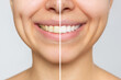 © Марина Демешко - Cropped shot of a young smiling woman before and after teeth whitening isolated on a gray background. Dark tooth enamel, contrast. Dentistry, dental care