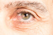 Close up of a eye of a senior man affected by pterygium