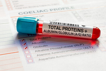 Wall Mural - Blood sample tube for analysis of Total Proteins + Albumin and Globulin A/G Ratio screening test in laboratory. Blood tube test with requisition form for Total Proteins + Albumin and Globulin A/G Rati