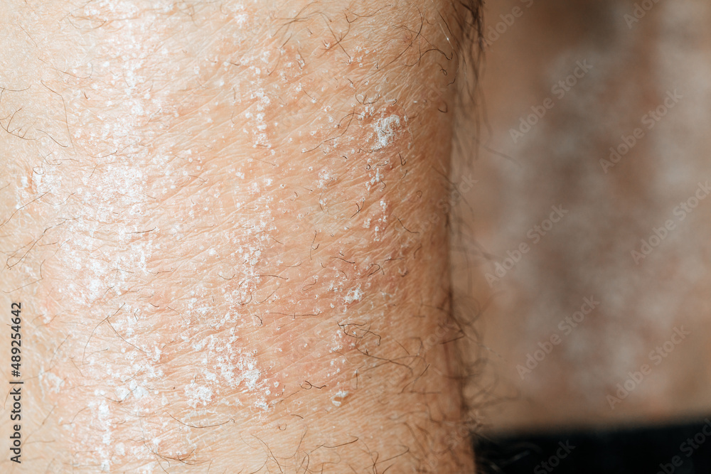 Acute psoriasis na is an autoimmune incurable dermatological skin disease. A large red inflamed flaky rash. Joints affected by psoriatic arthritis.